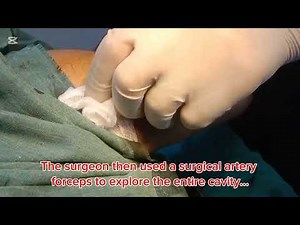 Axillary abscess drain