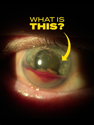 That “peanut butter & jelly” look is actually a severe hyphema—blood pooling inside the front of the eye.