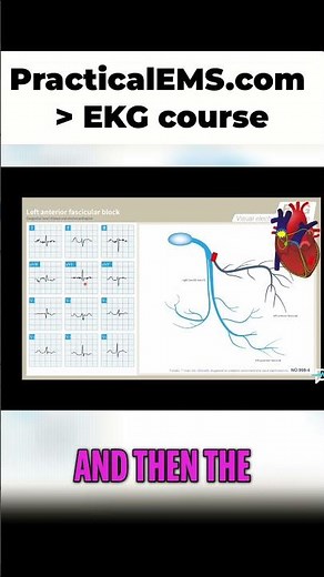 Left Anterior Fascicular Block Explained: ECG Interpretation