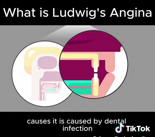 What is Ludwig's Angina?