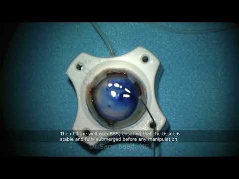 DMEK Surgery Part 1: Graft Preparation & Tear Management – SCUBA Technique | Dr Sami A. SAAD