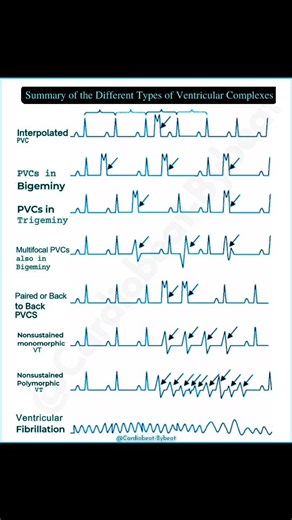 Abdallah Othman on Instagram: "Summary of the different types of ventricular complexes. Ventricular arrhythmias range from benign ectopy to lethal rhythms. Key entities include: •Isolated PVCs: Interpolated (no pause), Bigeminy (every-other-beat), or Trigeminy (every-third-beat) patterns. •Complex Ectopy: Multifocal PVCs (multiple foci) or paired PVCs (couplets) indicate heightened instability. •Tachyarrhythmias: Nonsustained VT (monomorphic/polymorphic; ≥3 beats,