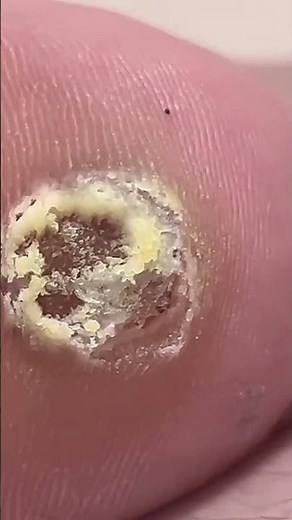 Satisfying Peel: Pulling Out Wart Core ✂️ #shorts