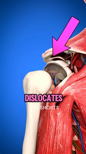 How to Fix Dislocated Shoulder