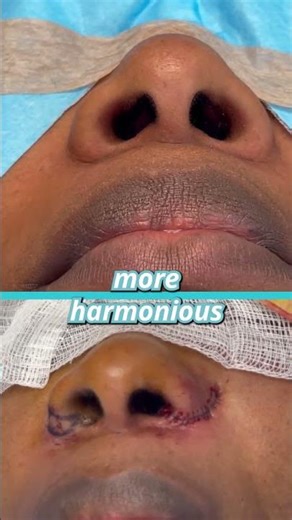 ALARPLASTY before and after for wide nostrils | Dr. Tanveer Janjua