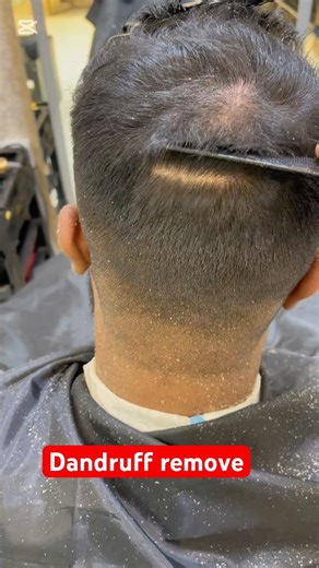 dandruff treatment: easy how-to to remove dandruff fast