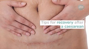 After a caesarean birth you will be uncomfortable for a few days. Taking regular pain relief is very important to your recovery. Let your midwife know if you require any pain relief or anti sickness medication. Your catheter, drip and wound drain (if you have one) will be removed in the first one to two days depending upon your recovery. | Pregnancy Babies and Children's Expo