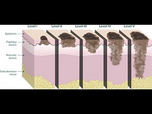 Breslow thickness measurement used in the staging of melanoma (Skin Cancer)