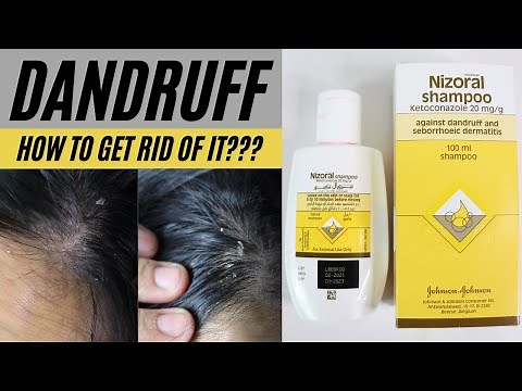 Dandruff | Flaky Itchy Scalp | Nizoral Shampoo Review