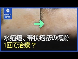 【日本字幕付】水疱瘡、帯状疱疹の傷跡の原因から1度に治療する方法まで