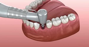 Implantation process in details: 3D animation of implantat instalation