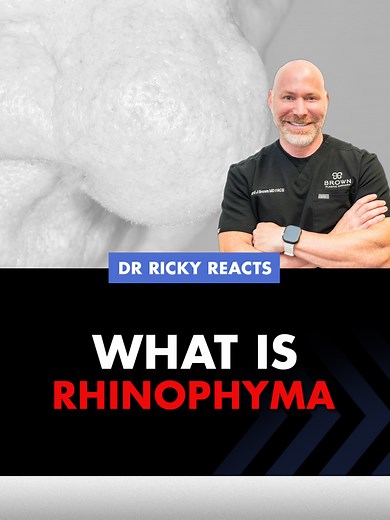 This is how CO2 Ablation works in treating Rhinophyma, the most severe form of Rosacea. It is treatable, and early care can make a big difference.