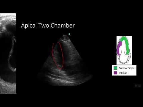 Point-of-Care Echo: Regional Wall Motion Abnormalities