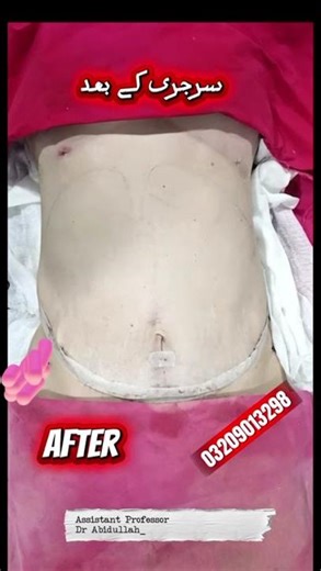 Tummy Tuck Surgery by Dr. Abdullah | Full Abdominoplasty Transformation