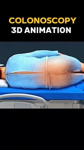 49K views · 779 reactions | Colonoscopy animation ✅ Follow me for...