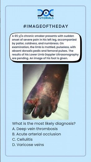 👉 Sudden Leg Pain, Pallor and No Pulse: What’s the Diagnosis?