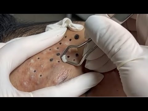 Extreme Pimple Popping Blackhead & Whitehead Extraction ASMR