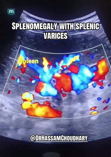 Understanding Splenomegaly and Its Implications