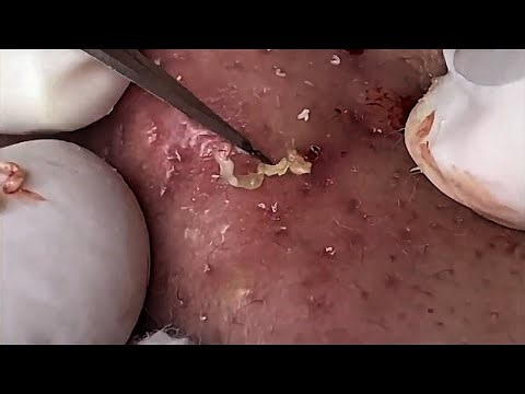 pimple popper blackhead ,blackhead removal satisfying #akne ^#extraction #sivilce #skincare 5