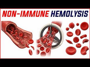 Non-Immune Hemolysis Internal Medicine🧪 DAT-Negative Causes, Management | USMLE Step 2 CK