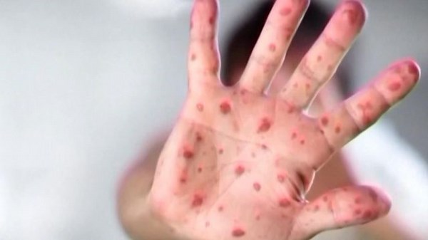 U.S. measles cases now exceed 1,100