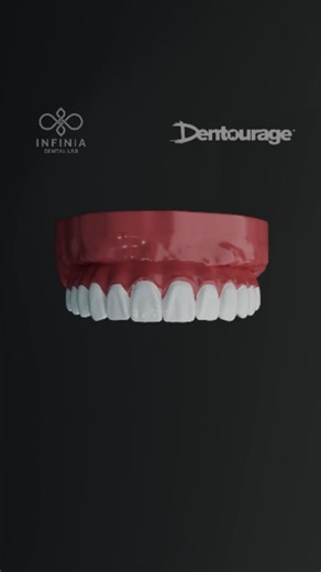 Infinia Dental Lab on Instagram: "See how a full digital workflow with Micron Mapper made this full-mouth transformation predictable – from scan ➡️ guided surgery ➡️ final smile, with no surprises in between. Save this post for your next big case, and drop a comment if you have questions! #dentistry #dentalimplant #digitaldentistry #smilemakeover #micronmapper"