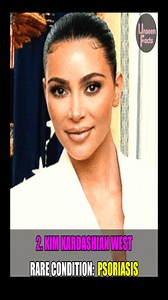 3.2K views · 53 reactions | Kim Kardashian West Rare Condition #psoriasis #autoimmunedisease #rarediseaseawareness #raredisease #celebritynews #celebrity #kimkardashian | Unseen Facts Compilations | Facebook