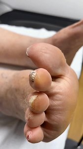 25K views · 41 reactions | Get your toes summer-ready! Watch our Aussie podiatrist expertly remove toe callus. . . . #footpain #plantarfasciitis #heelpain #podiatry #footcare #podiatrist #orthotics #feet #foothealth #kneepain #foot #running #anklepain #backpain #bunions #flatfeet #healthyfeet #footpainrelief #arthritis #health #footdoctor #bunion #fyp #foryou #viralreels #explore | Docpods Treatment | Facebook