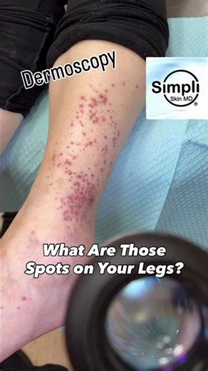 What Are Those Spots On Your Legs? Come See What Your Dermatologist Sees!
