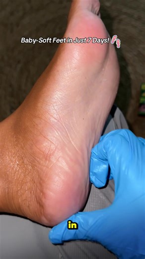 #selflove #footcare #foryou #tiktkshop #fyp #athletesfoot #deadskinremover #footsupport