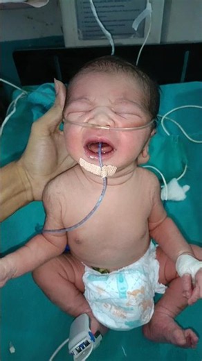 Moro Reflex newborn #nicu #medical #baby #neonatologist #premature #cutebaby