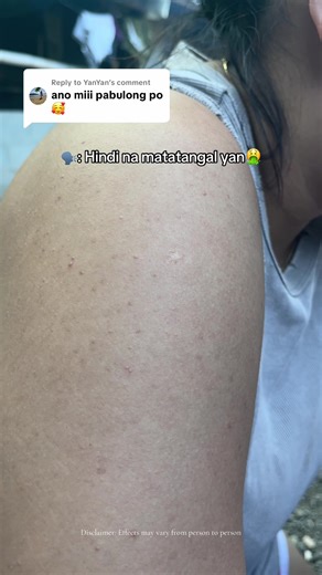 Effective Bacne Treatment Tips for Clear Skin