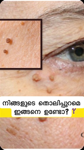 Ammar Abdulla Kp on Instagram: "നിങ്ങളുടെ തൊലിപ്പുറമെ ഇങ്ങനെ ഉണ്ടോ? എന്താണ് കാരണം, പകരുമോ, എങ്ങനെ പരിഹരിക്കാo പരിശോധനക്ക്മുൻകൂട്ടിബുക്ക് ചെയ്യുക. Skin Tag 🔹 Common causes: • Hormonal imbalance • Obesity • Diabetes & insulin resistance • PCOD / PCOS • Friction of skin 🔹 Important facts: ✔️ Harmless ✔️ Not cancer #SkinTag #SkinTagRemoval #SkinCareAwareness #HealthTips #Dermatologyq#"