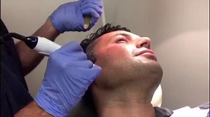 PRP Microneedling Treatment Demonstration