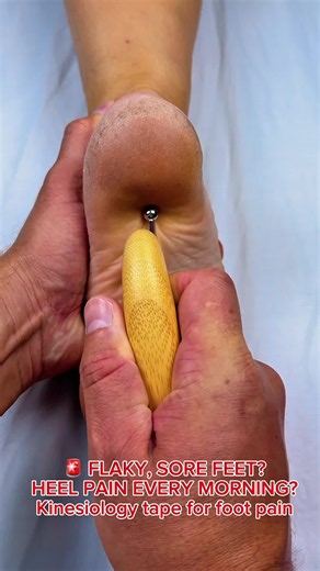 🚨 FLAKY, SORE FEET? HEEL PAIN EVERY MORNING? YOUR FEET MAY BE SCREAMING FOR SUPPORT! 🦶🔥 Watch this STEP-BY-STEP kinesiology taping technique for tired, painful feet 👇 1️⃣ PLANTAR FASCIA — tape helps provide gentle support along the bottom of the foot. 2️⃣ HEEL — strategic placement can help reduce stress around a sensitive heel. 3️⃣ ARCH — support the arch without completely restricting movement. 4️⃣ ACHILLES — extend the support toward the Achilles when the calf and tendon area feel tight. 