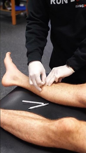 Dry Needling for Shin Splints