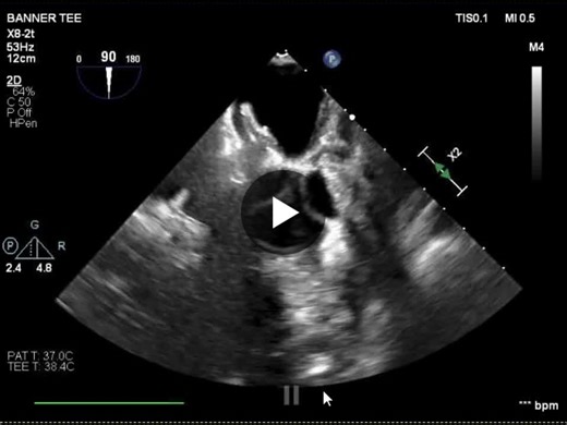 PFO Closure for Secondary Stroke Prevention in High-Risk Patients | dexter deleon posted on the topic | LinkedIn