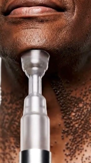 Most Satisfying Blackhead Vacuum Extraction Ever! Real Deep Pore Cleaning ASMR for Stress Relief,