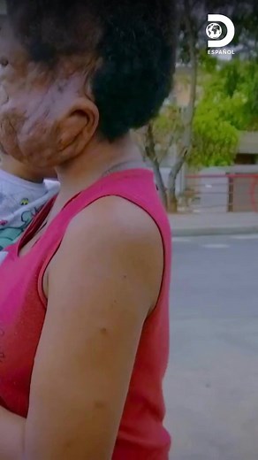 1.5M views · 45K reactions | Lo que comenzó como una condición heredada se convirtió en un desafío devastador: un tumor facial sin cura transformó por completo la vida de esta mujer en Brasil. 溺 #MiCuerpoMiDesafío Disfruta el contenido de Discovery en #HBOMax Suscríbete ahora: https://bit.ly/MAX-DiscoveryEsp | Discovery en Español | Facebook