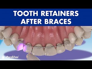 TOOTH RETAINERS after braces - How to PREVENT MOVING teeth after orthodontics ©