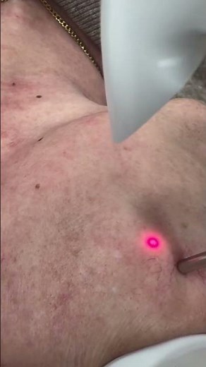 Lasersko uklanjane kapilara kod rozacee NdYAG Fotona laserom 🔴