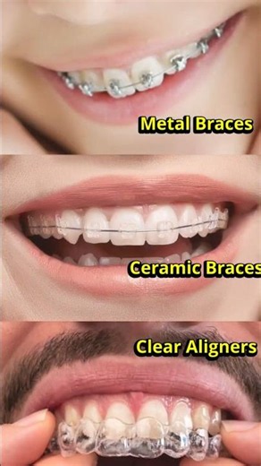 Braces vs Aligners | Metal Braces, Ceramic Braces or Aligners? Which is Best? 🤔