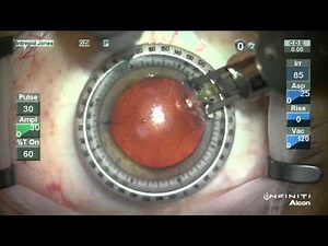 Corneal Relaxing Incision Technique • Video • MEDtube.net