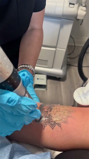 pfd patch tatto removal