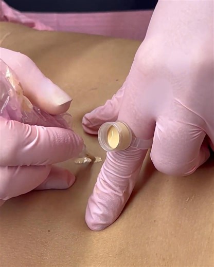 Wondered How Scar Camouflage Can Turn Imperfections Into Confidence Boosters? Here's The Scoop: Scar Camouflage Isn't Just About Hiding Marks—It's About Changing How People See Themselves. With Specialized Pigment Matching And Precise Techniques, Scars From Surgery, Injury, Or Burns Can Blend With Natural Skin Tones. 🎯 For Example, Our Students Have Mastered Techniques That Reduce Scar Visibility By Up To 80%, Helping Clients Regain Their Self-Esteem Instantly. One Recent Graduate Shared How Sh