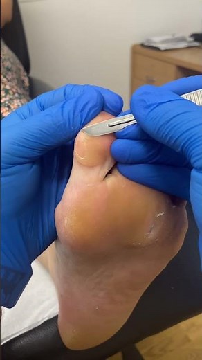 Get ready for a toe transformation! Watch an Aussie podiatrist work magic on thick callus removal