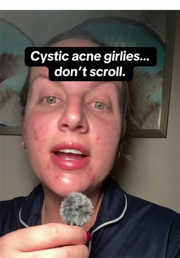 Soothing Cystic Acne Treatment for Fast Relief