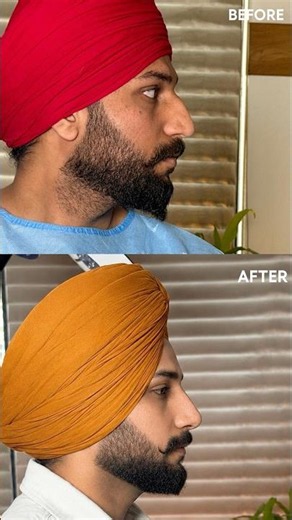 Real Rhinoplasty Result 👃 Natural Nose Job Before & After | Dr. Vikas Gawri