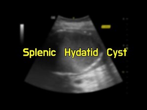 Splenic Hydatid Cyst