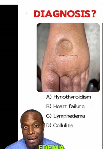 That dent you see after pressing on swollen skin? It’s called pitting edema, and it’s your body’s way of waving a red flag that something deeper could be going on. #EdemaExplained #BodySignals #HealthEducation #RadiologyView #KnowYourBody Disclaimer:This content is for medical education purposes only and should not be used as a substitute for professional medical advice, diagnosis, or care. Always talk to your healthcare provider about any health concerns.